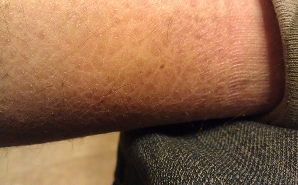 Mild Ichthyosis Vulgaris