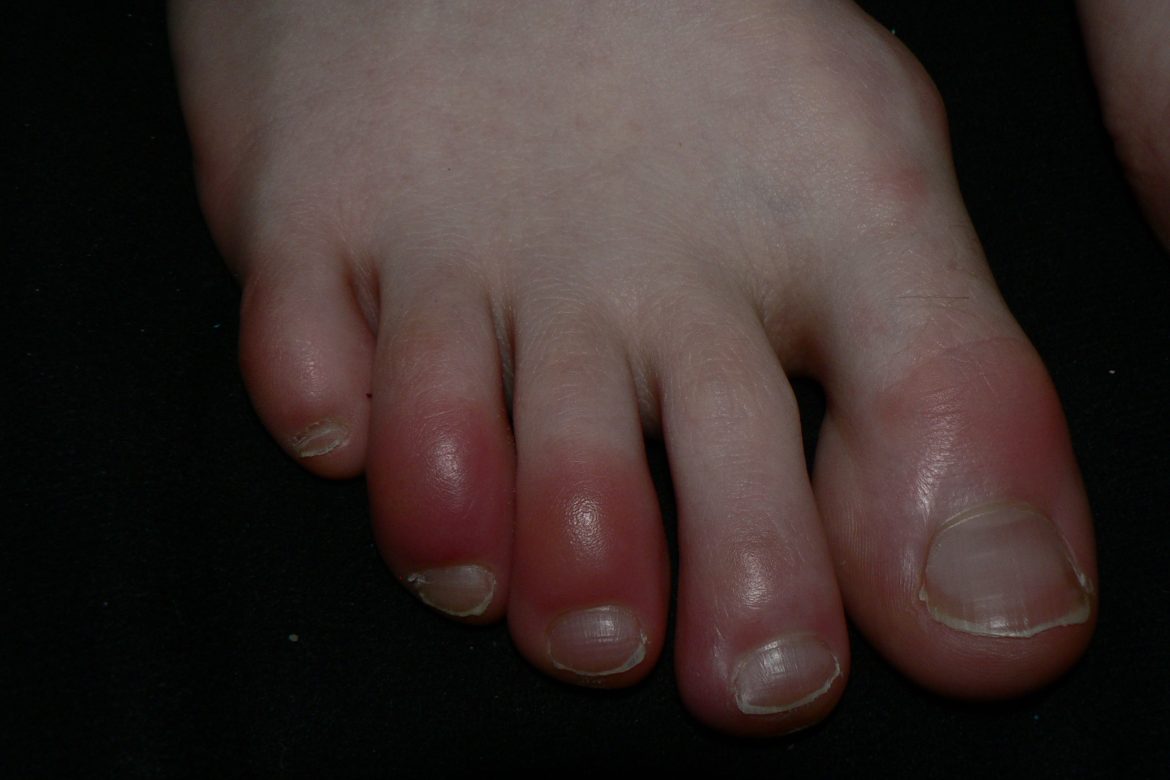 Inflammation